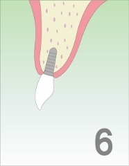 大口式　施術方法6