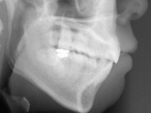 矯正治療後　レントゲン