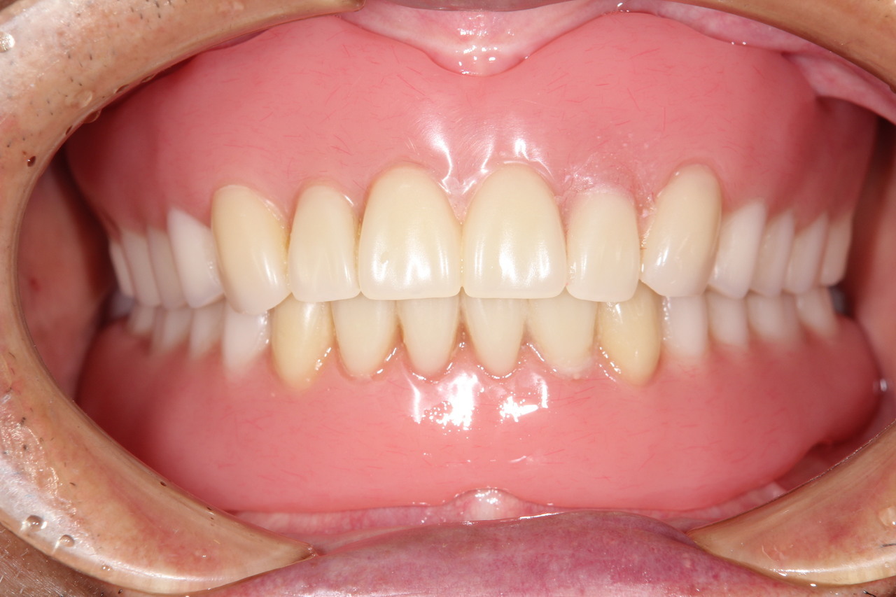 インプラントオーバーデンチャー