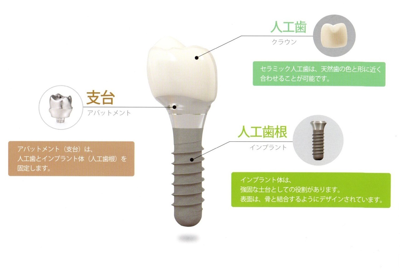 インプラント
